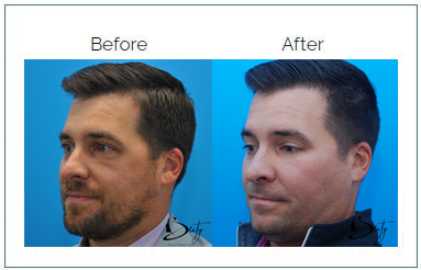 facial implants2 facial implants2