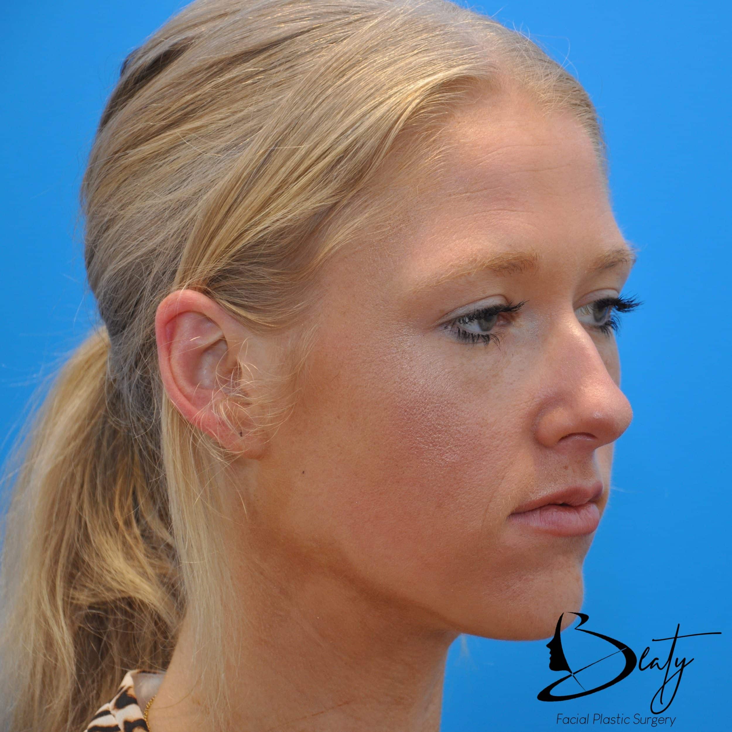 After Image