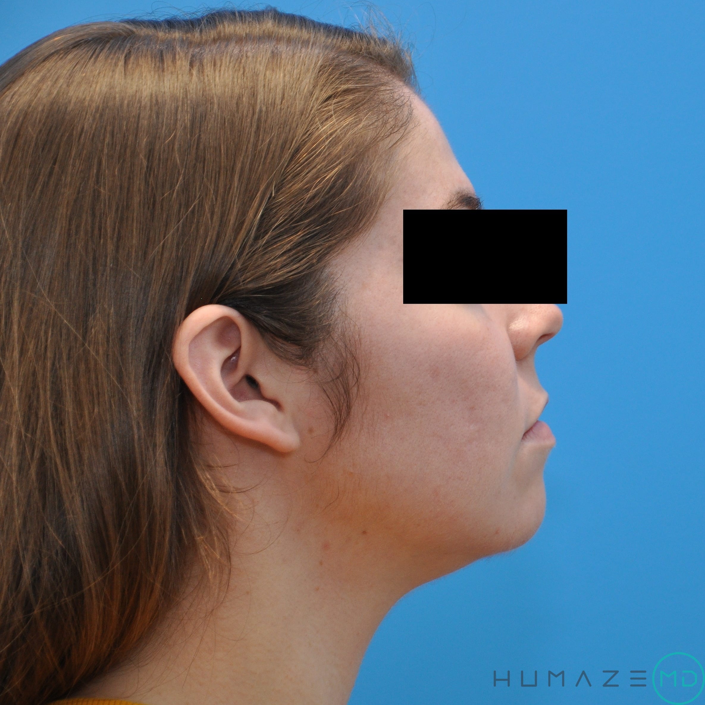 CO2 laser resurfacing