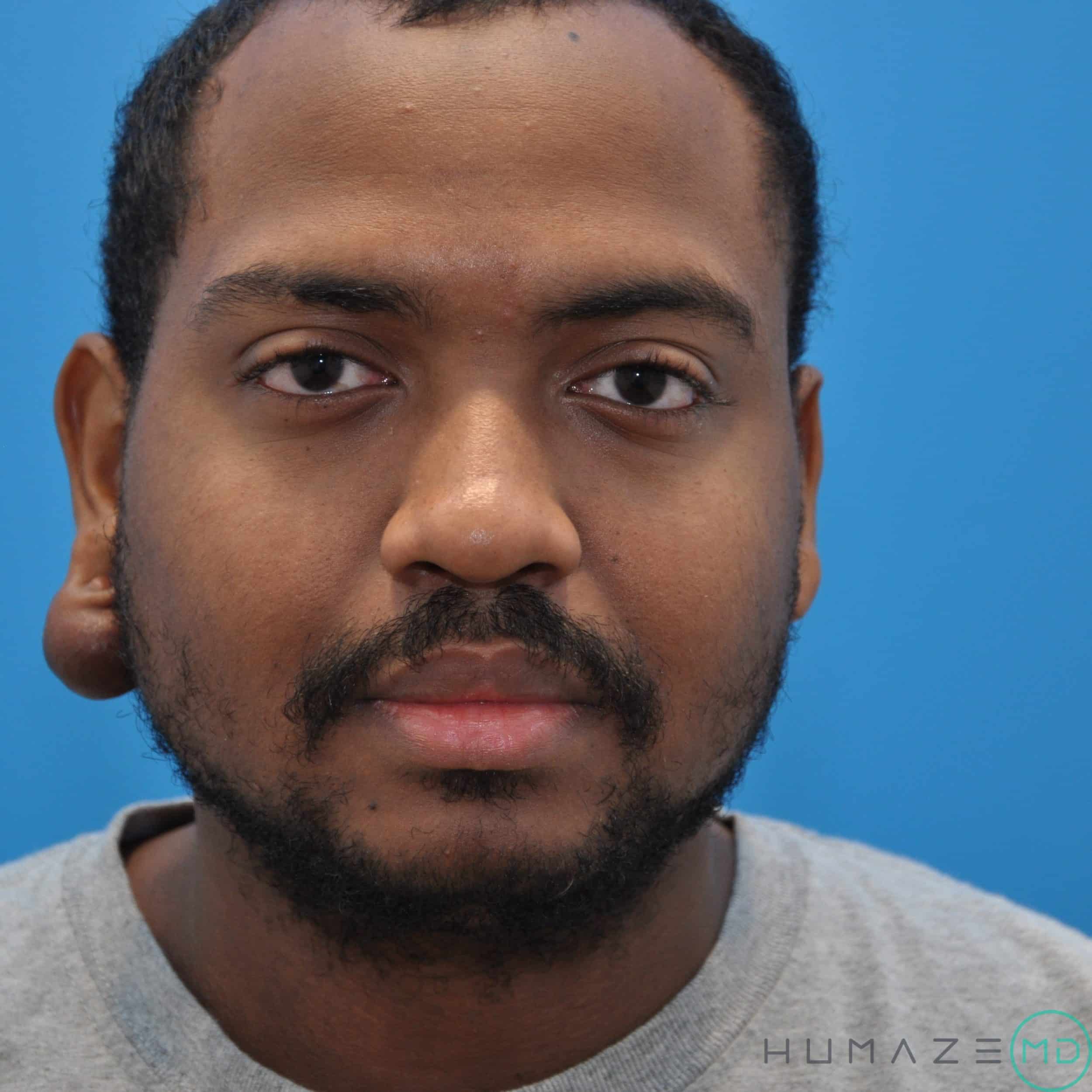 keloid scar removal