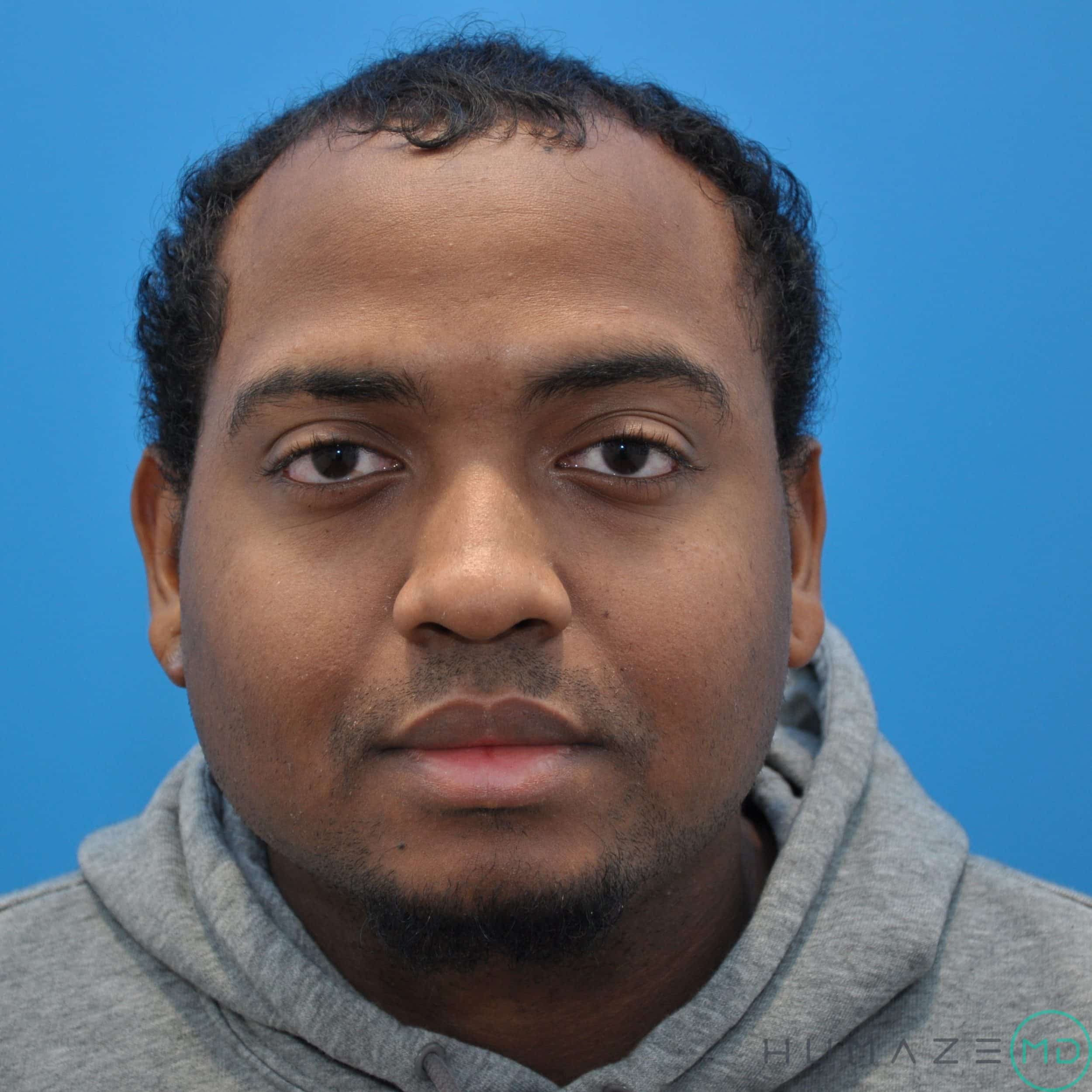 keloid scar removal