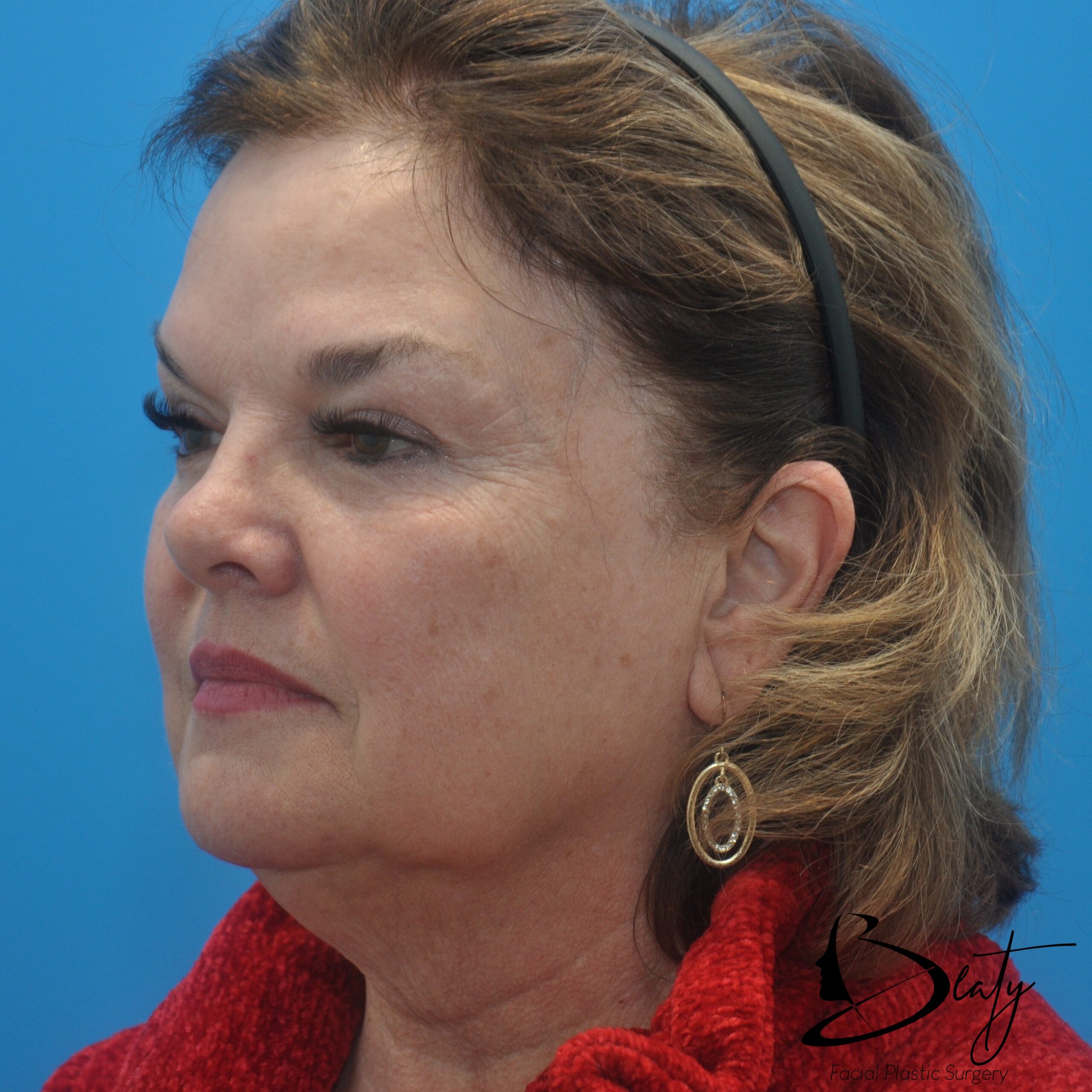 FACELIFT (PROLIFT™) / Neck Lift / CO2 resurfacing