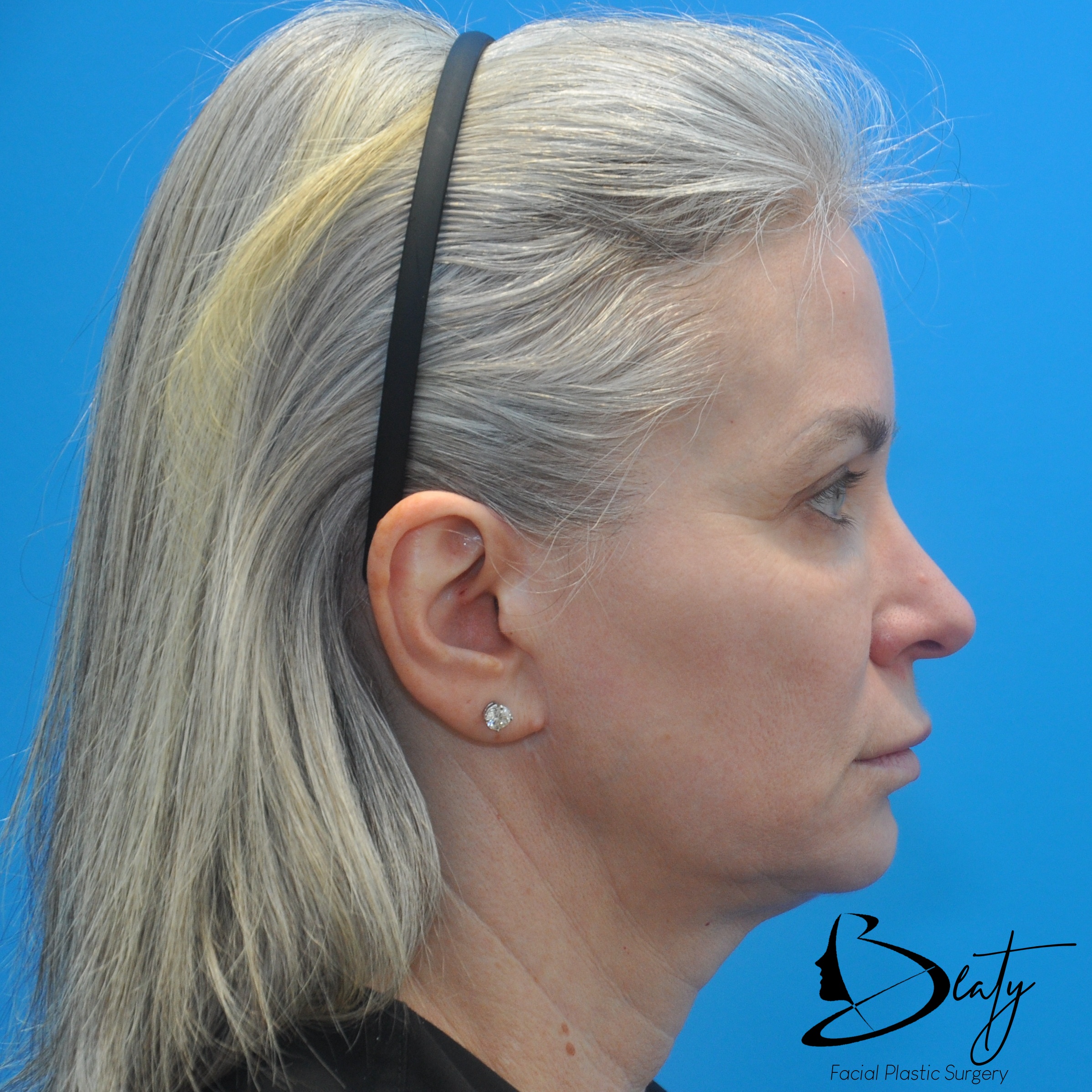 FACELIFT (PROLIFT™) / Brow Lift / CO2 Resurfacing