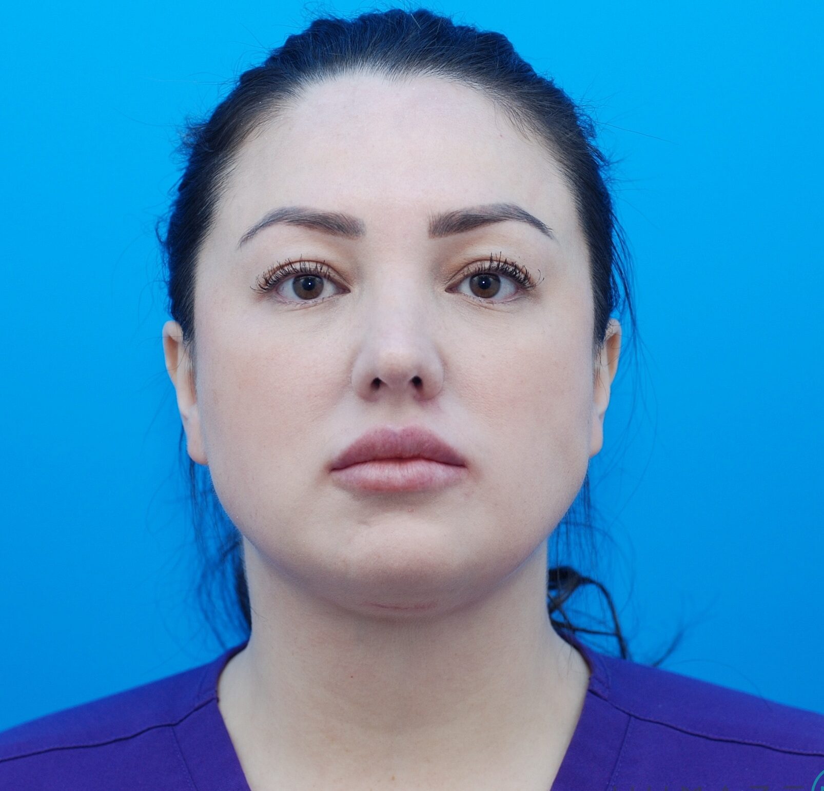 Neck Lift / Rhinoplasty / Buccal Fat Removal / Lip Filler