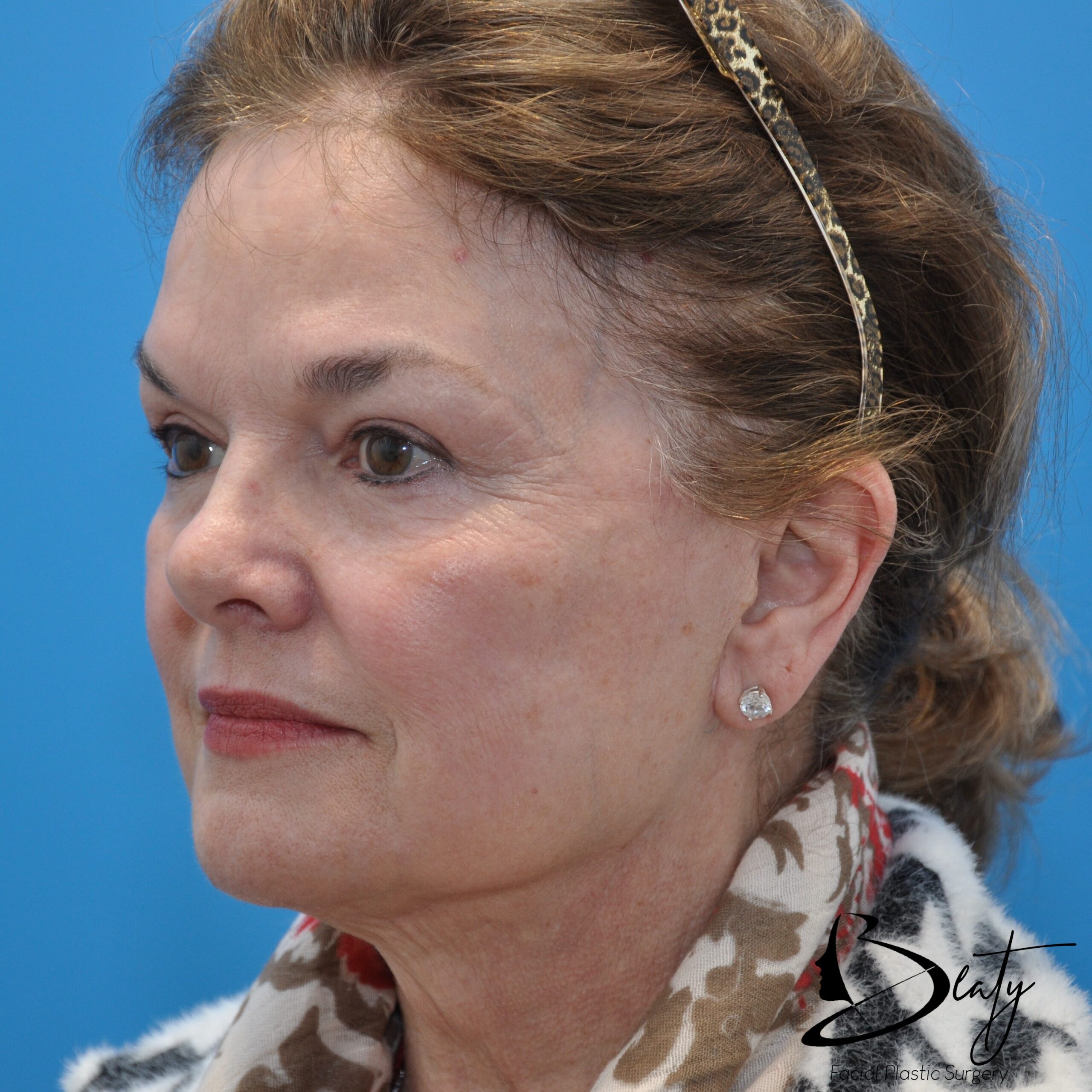 FACELIFT (PROLIFT™) / Neck Lift / CO2 resurfacing