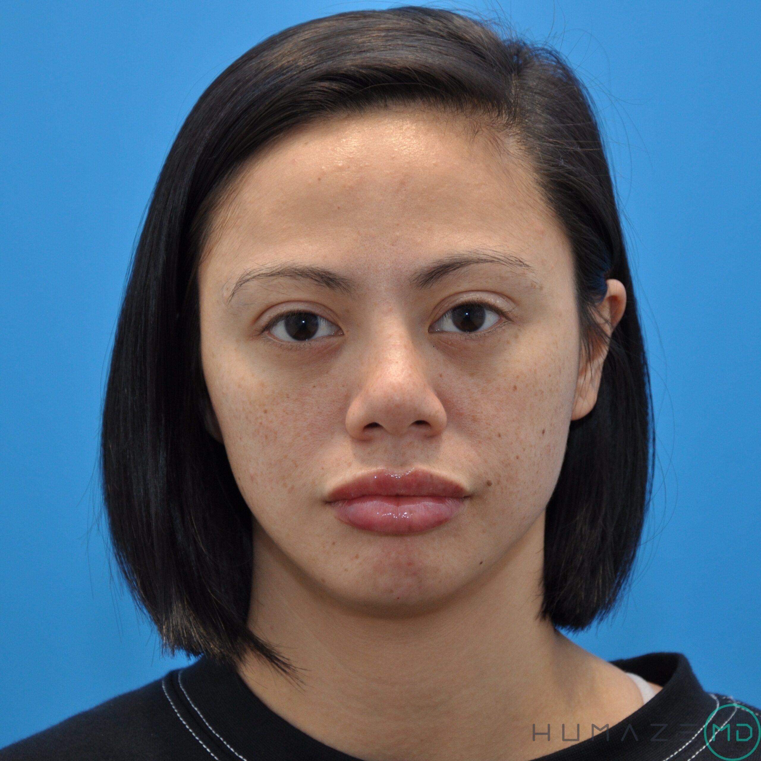 Fillers & Injectables