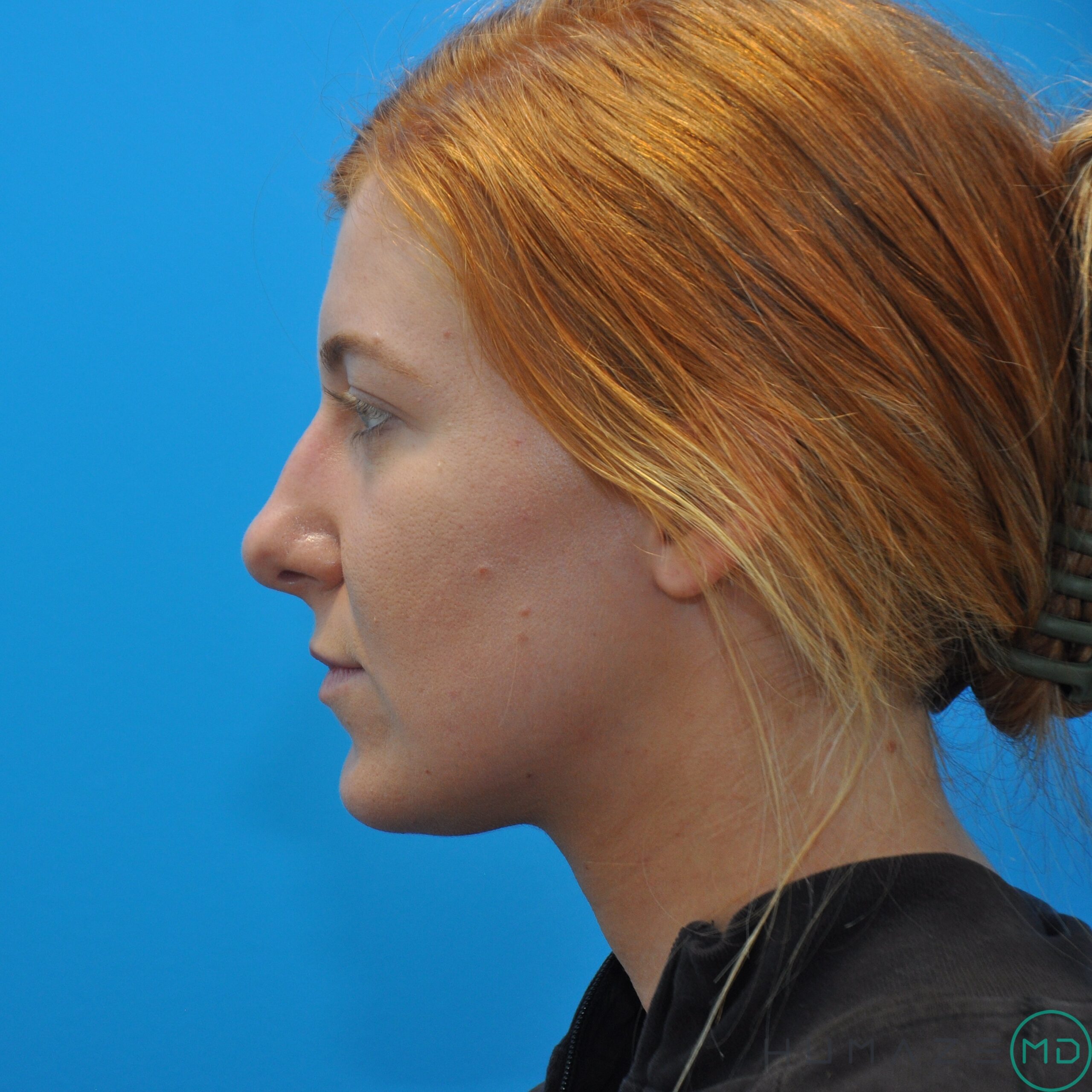 rhinoplasty