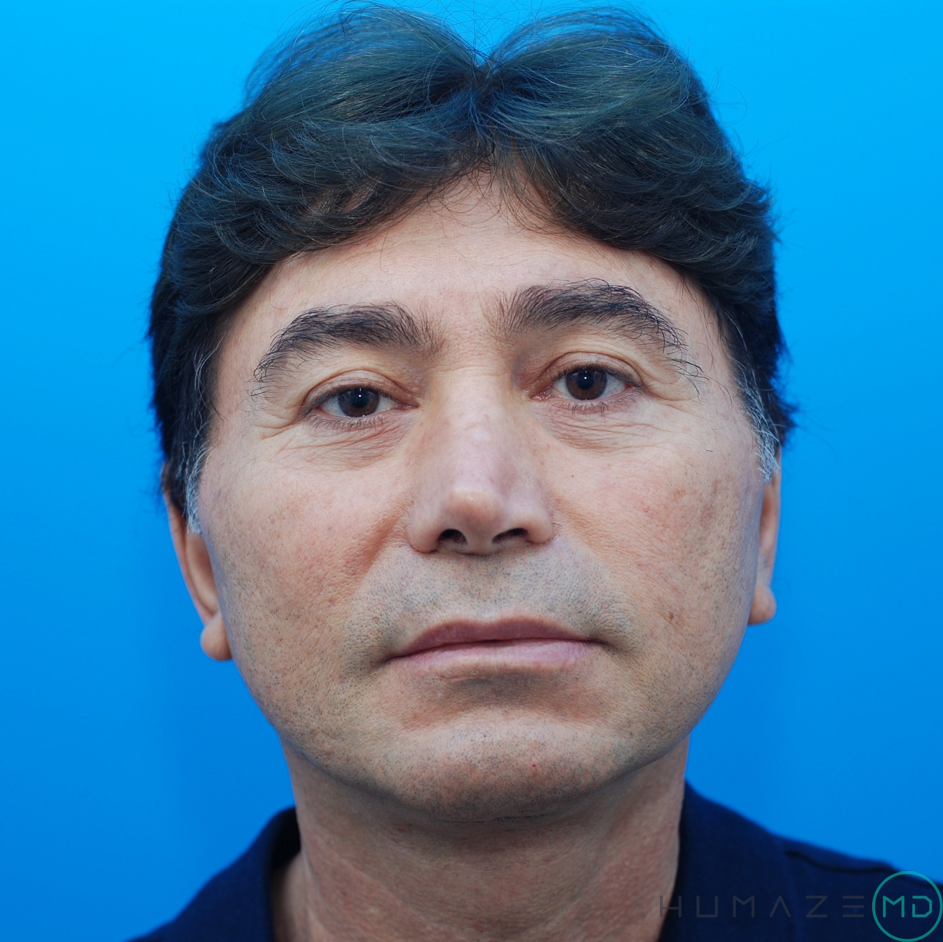 Facelift & Fat Grafting