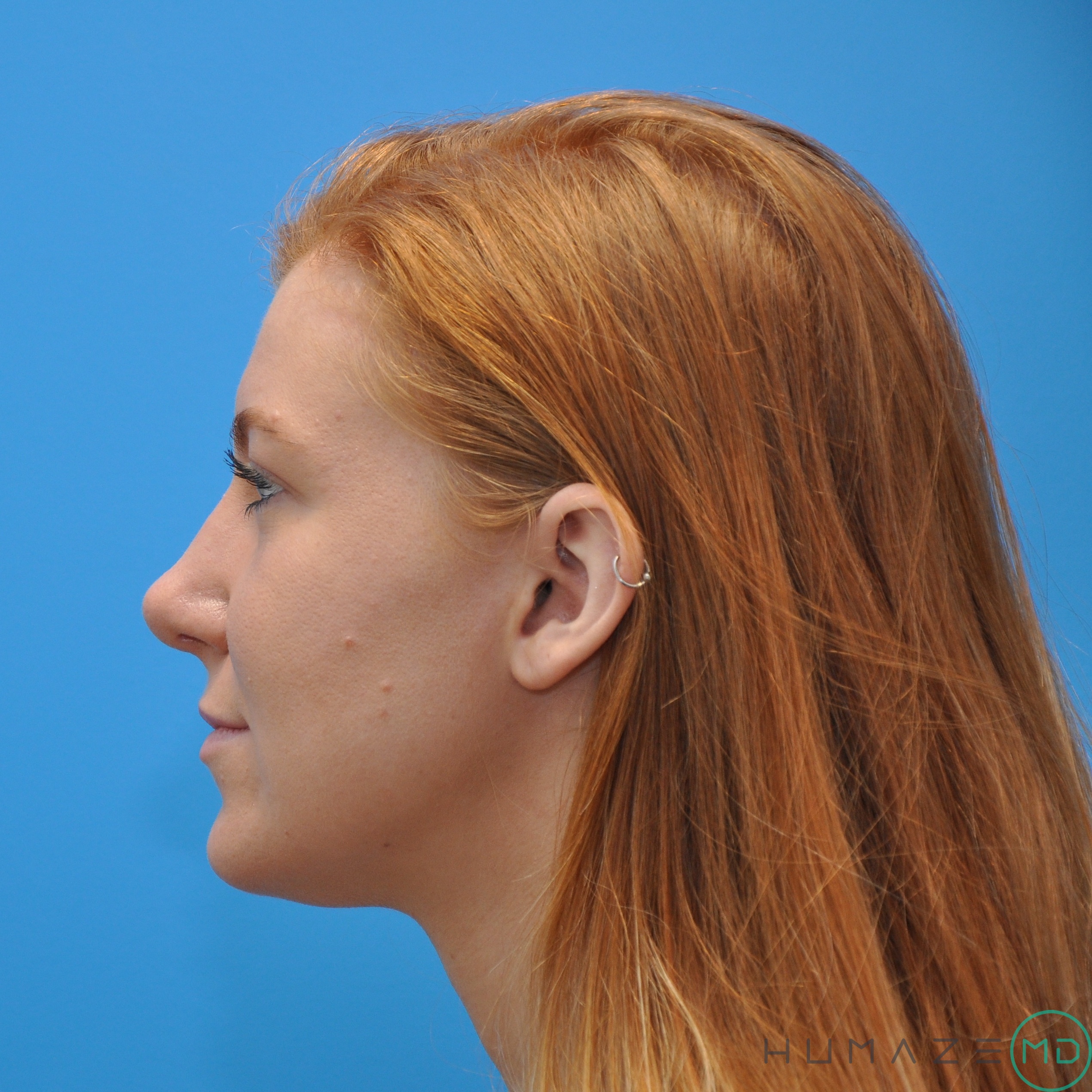 rhinoplasty
