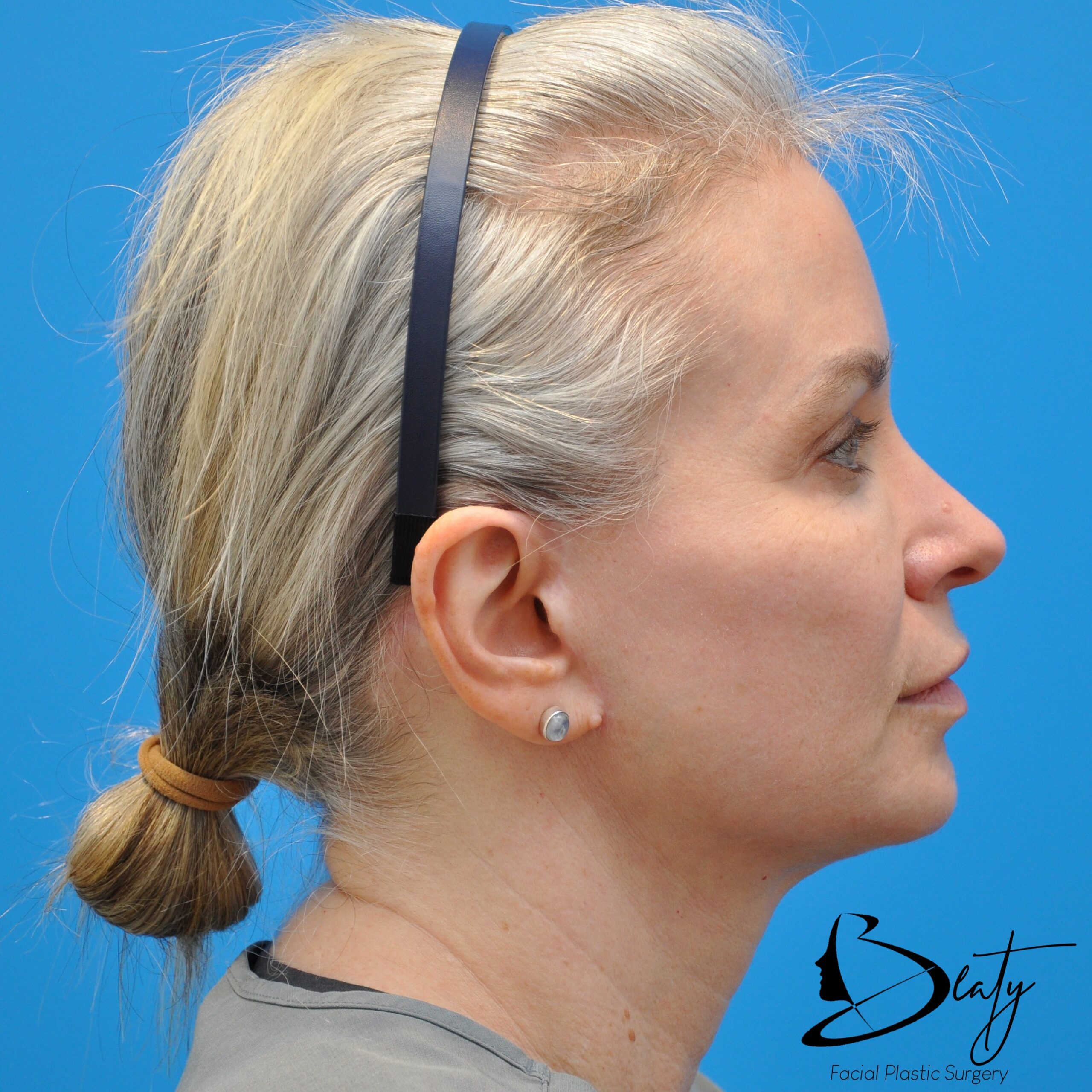 FACELIFT (PROLIFT™) / Brow Lift / CO2 Resurfacing