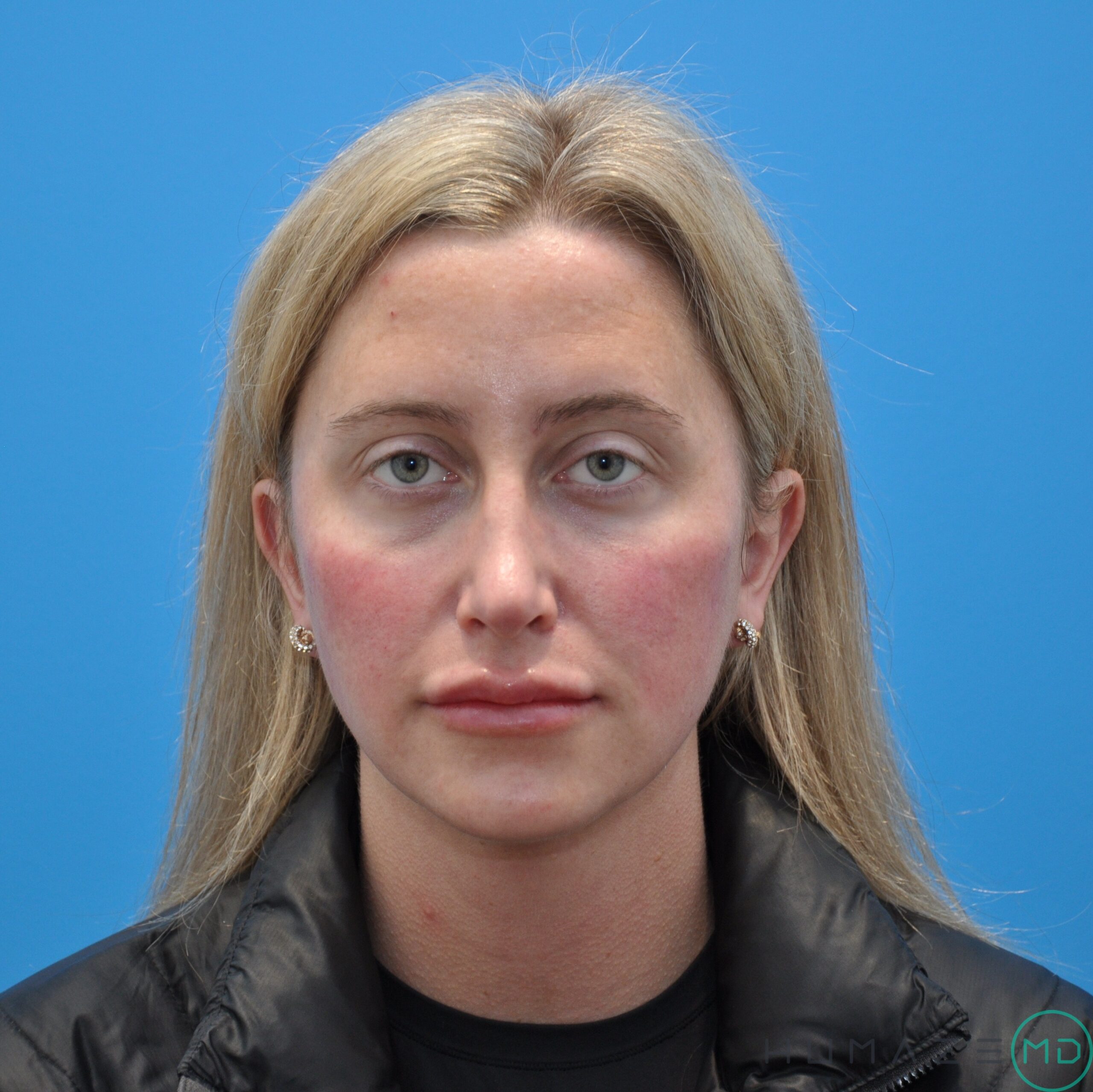 Fillers & Injectables – Lips & Cheeks