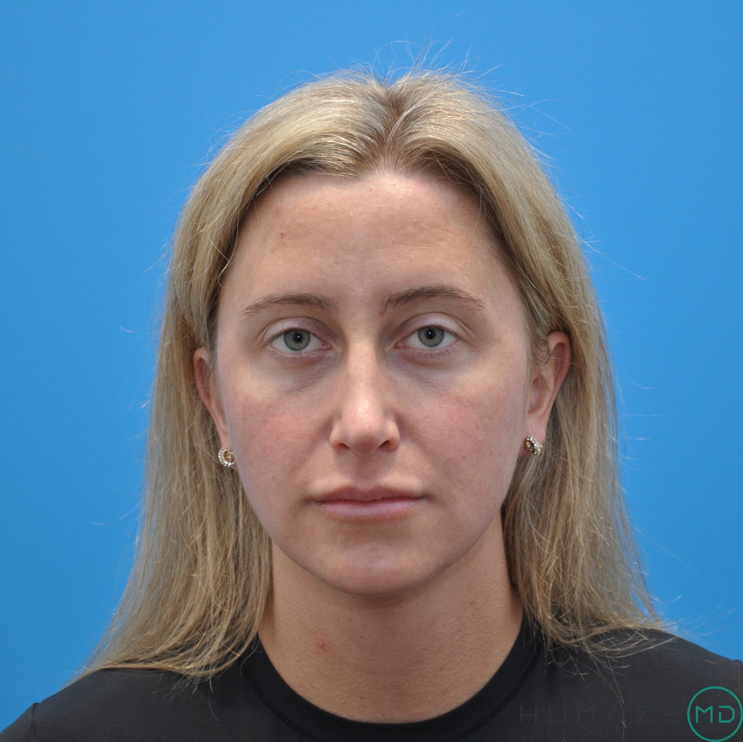 Fillers & Injectables – Lips & Cheeks