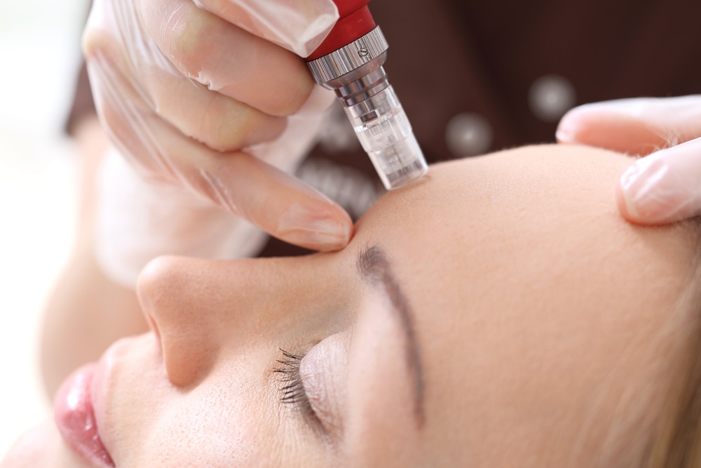Needle mesotherapy