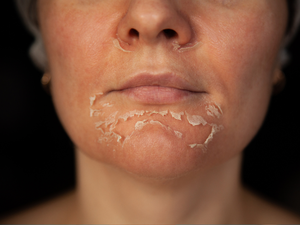 Skin resurfacing