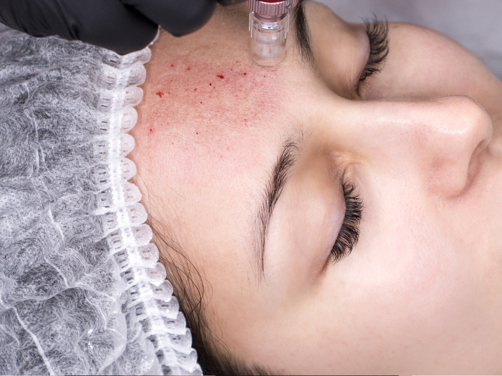 Close-up of microneedling treatment in progress for skin rejuvenation