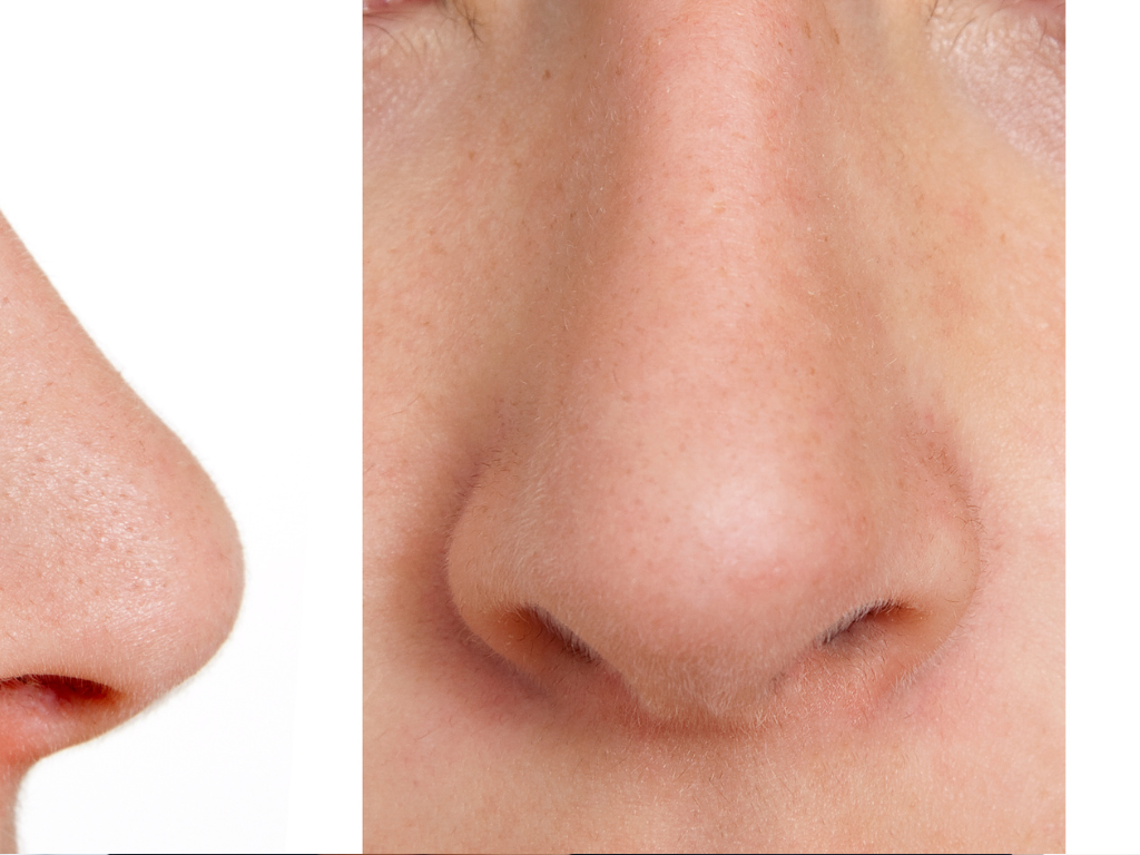 Side profile before and after rhinoplasty for facial balance and refinement.