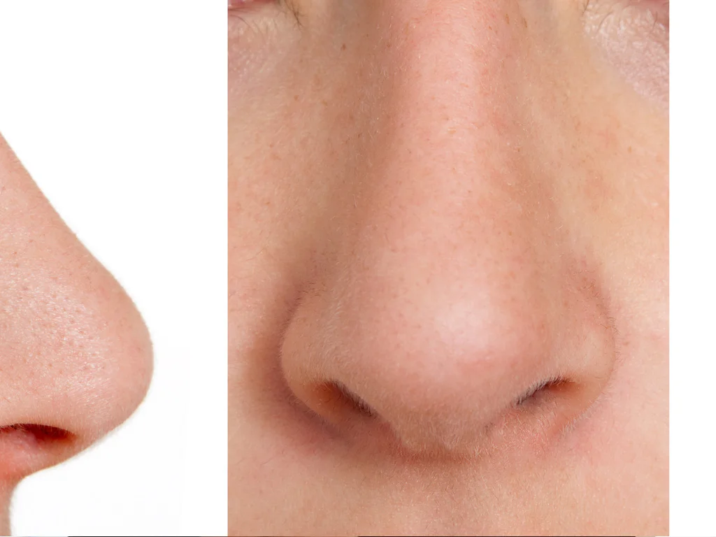 Side profile before and after rhinoplasty for facial balance and refinement.