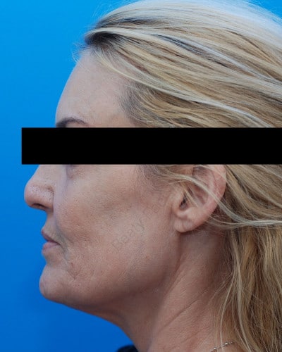 Before Image