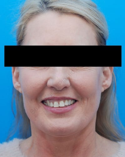 After Image