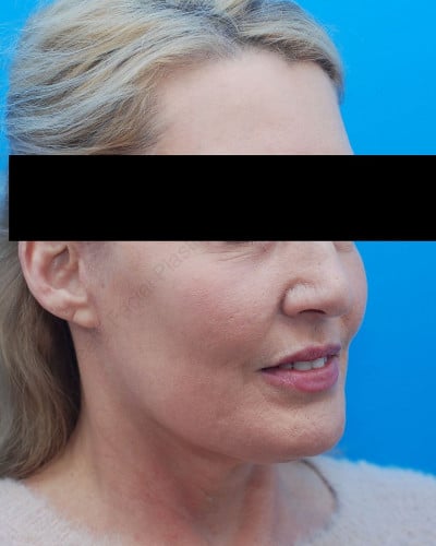 After Image