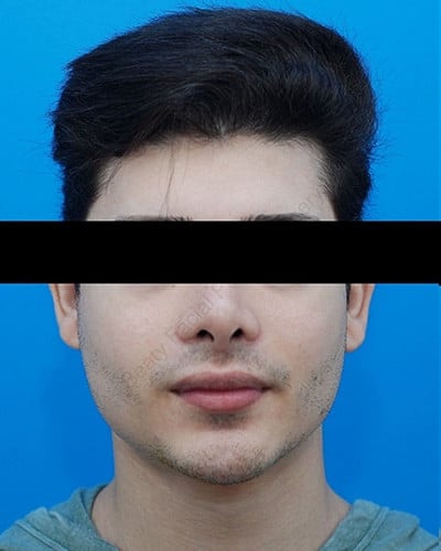 Before Image