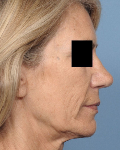 After Image
